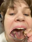 Боль в соседних зубах после ударения зуба фото 1