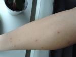 Сыпь на ногах сильно чешется похожа на комариные укусы фото 3