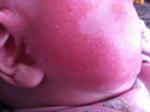Аллергический дерматит у ребенка фото 1