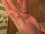 Новообразования на пальцев руки фото 1
