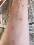 Сыпь на теле красного цвета похожие на укусы Комаров фото 2