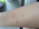 Сыпь на ногах сильно чешется похожа на комариные укусы фото 4