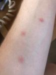 Сыпь на теле красного цвета похожие на укусы Комаров фото 3