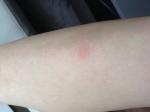 Сыпь на ногах сильно чешется похожа на комариные укусы фото 5