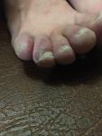 Покраснения на пальцах ног фото 1