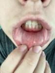 Отёк губы с несколькими уплотнениями в нижней губе фото 1