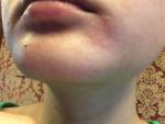 Покраснение и шелушение у уголка губ и под нижней губой фото 1