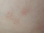 Атонический дерматит, лишай или инфекция? фото 4