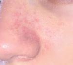 Красные болезненные пятна вокруг носа фото 1