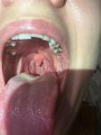 Жжение на слизистой в полости рта, небе, внутренней сторонах губ, фото 2