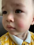 Красное пятно на щеке у ребенка 3 дня не отходит фото 1