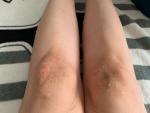 Сыпь на коленях с зудом после родов фото 1