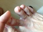Сыпь между пальцами ног, и на верхней части стопы фото 2