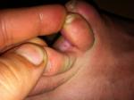 Грибковое заболевание стоп, пальцев ног, фото 1