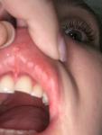 Жжение на слизистой в полости рта, небе, внутренней сторонах губ, фото 5