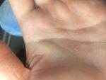 Уплотнения и трещины на пальцах рук фото 3