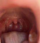 Шишка на задней стенке глотки фото 1