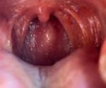 Шишка на задней стенке глотки фото 2