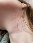 Гнойничковые высыпания на лице, шее и груди фото 2