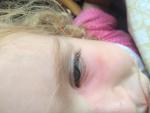 У ребёнка 2-х лет отек и покраснение уголка глаза фото 1