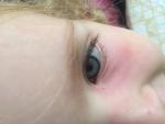 У ребёнка 2-х лет отек и покраснение уголка глаза фото 2