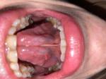 Увеличена миндалина, болит язык фото 2