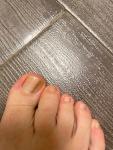 Темная полоса на ногте большего пальца ноги фото 1