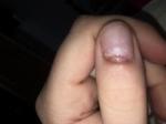 Пузырь из кожи на ногте с прозрачной жидкостью фото 1