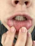 Отёк губы с несколькими уплотнениями в нижней губе фото 2