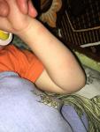 Дерматит и аллергия у ребёнка двух лет фото 1
