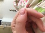 Пузырь из кожи на ногте с прозрачной жидкостью фото 2