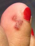 Темное пятно на пальце ноги, вдруг меланома? фото 2