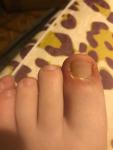 После удаления вросшего ногтя болит кожа пальца! фото 1