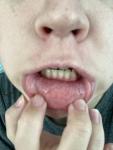 Отёк губы с несколькими уплотнениями в нижней губе фото 3