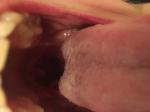 Боль и ком в горле, жжения языка (чувство удушья) фото 2