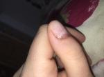 Пузырь из кожи на ногте с прозрачной жидкостью фото 3
