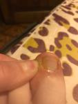 После удаления вросшего ногтя болит кожа пальца! фото 2