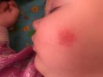 Красное пятно на щеке у ребенка фото 2