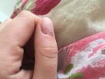 Пузырь из кожи на ногте с прозрачной жидкостью фото 4