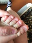 Слоятся ногти на ногах у ребенка фото 2