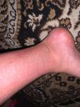 Красные пятна на икрах ног без чесания фото 4