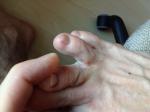 Сыпь между пальцами ног, и на верхней части стопы фото 1