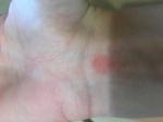 Красные пятна похожие на комариные укусы фото 2