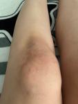Сыпь на коленях с зудом после родов фото 2