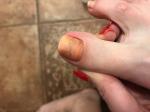 Проблема на больших пальцах ног фото 1