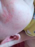 Сыпь с белыми головками на щеке у новорожденного фото 1