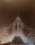 Рентген носа: незначительное искривление перегородки носа фото 1