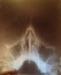 Рентген носа: незначительное искривление перегородки носа фото 3