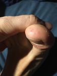 Красная точечная сыпь на пальце ноги фото 2
