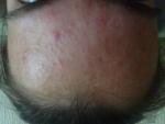 Мелкая сыпь на лбу, не аллергия фото 2